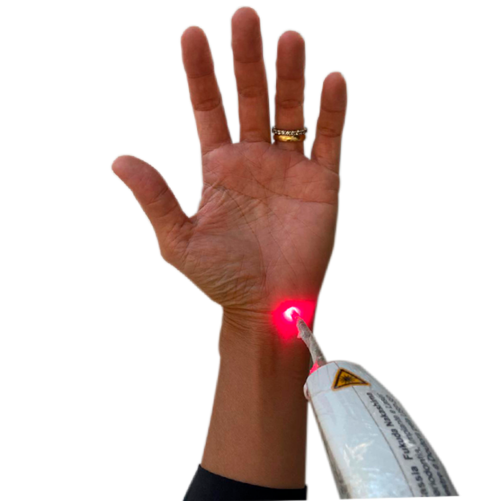 laserpuntura-acuponto-laser Mão e antebraço feminino um pouco mais magro, com um equipamento de laser de baixa potência sendo utilizada em um acuponto.