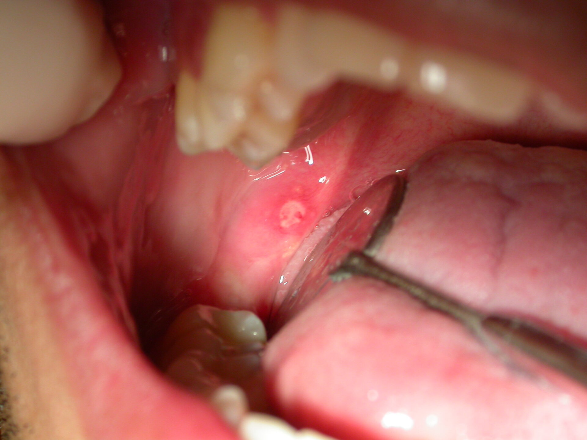 Afta e Herpes