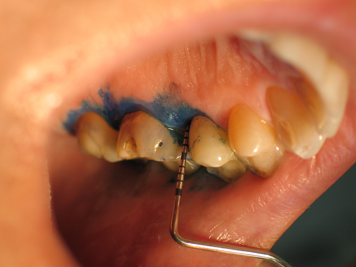 Terapia Antimicrobiana – PDT