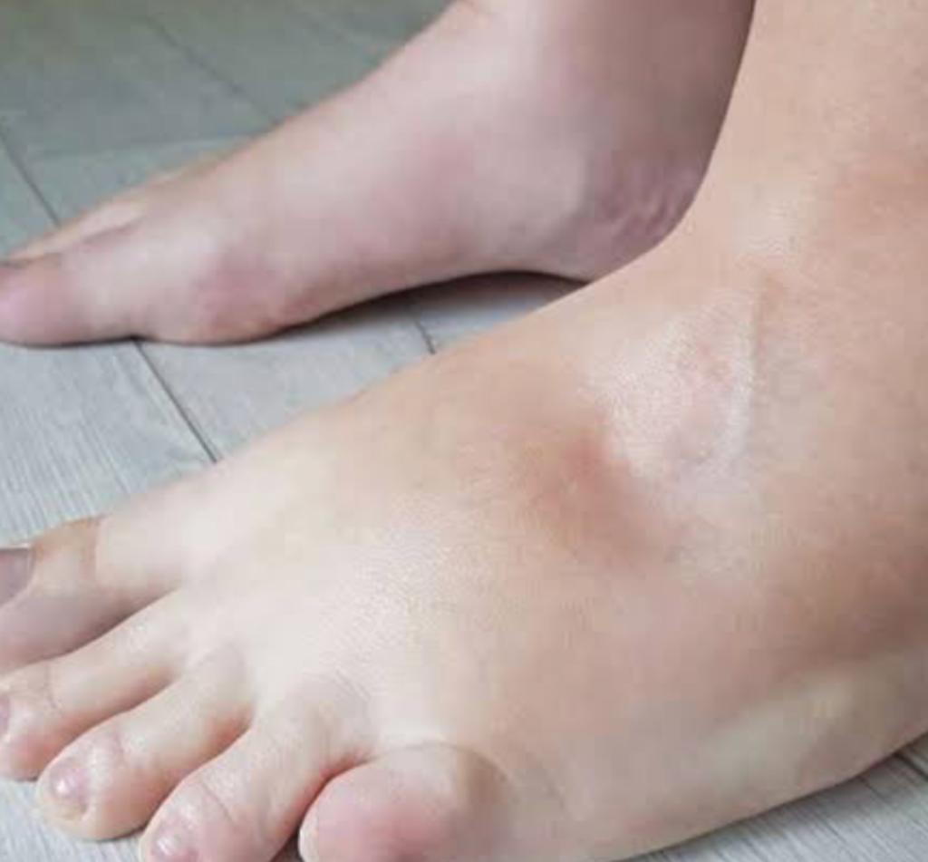 Pé com edema