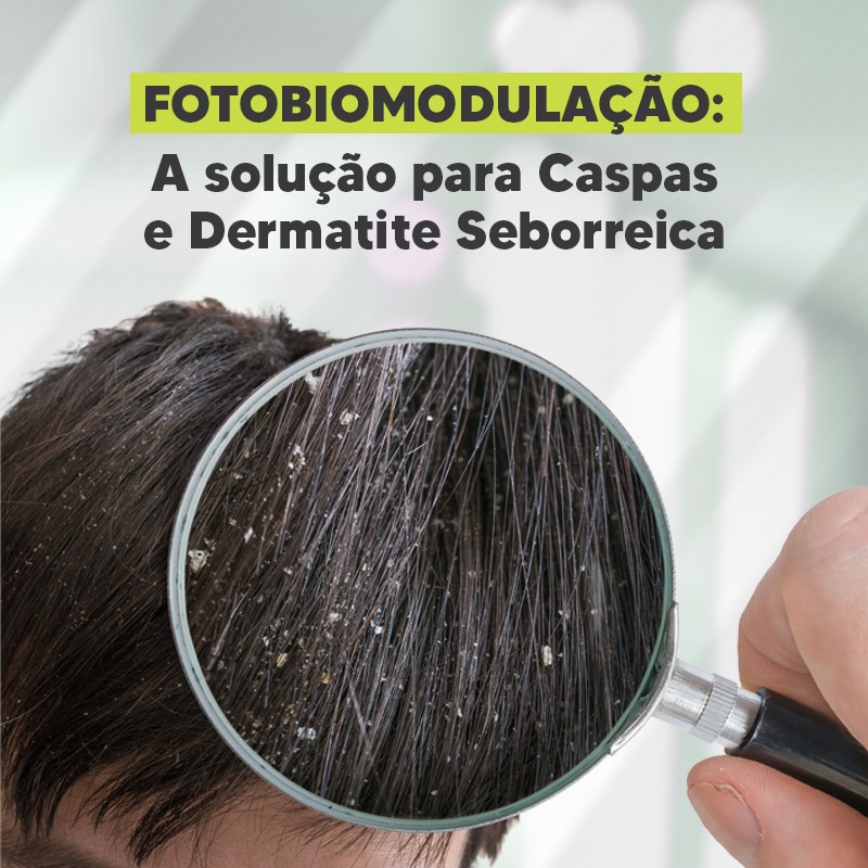 Fotobiomodulação: A solução para Caspas e Dermatite Seborreica