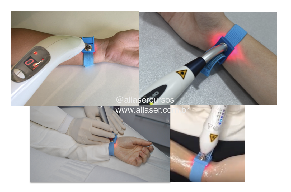 ILIB / Laserterapia SistÃªmica