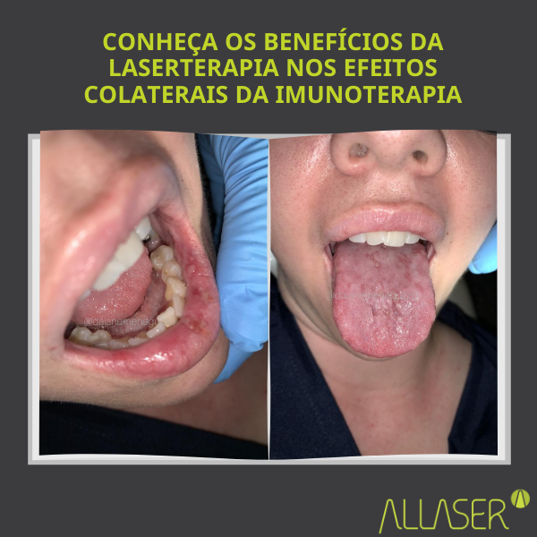 Conheça os benefícios da laserterapia nos efeitos colaterais da imunoterapia
